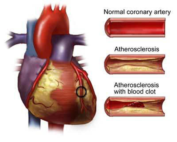 Heart Disease